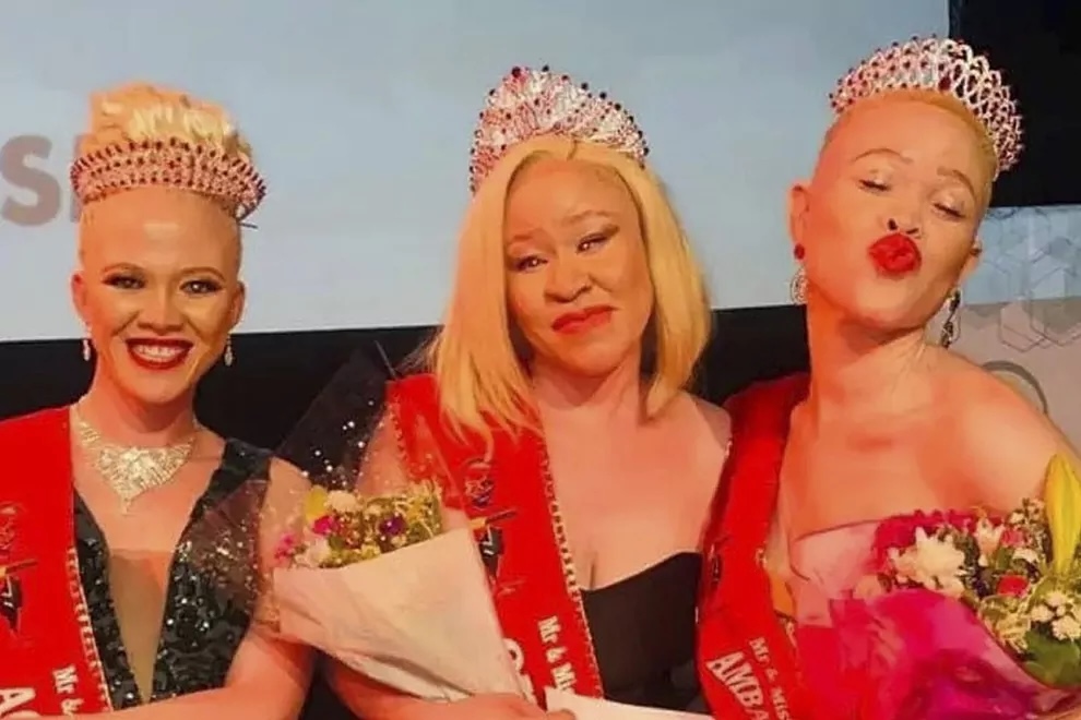 Zuid-Afrikaanse Shabangu is trots op haar albinisme